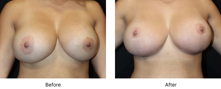 Breast Revision Before and After Las Vegas