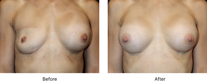 Breast Revision Before and After Las Vegas