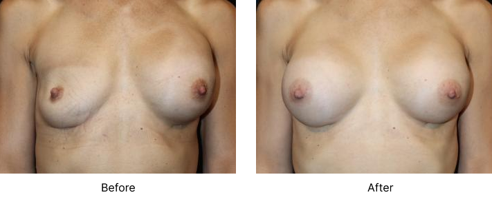 Breast Revision Before and After Las Vegas