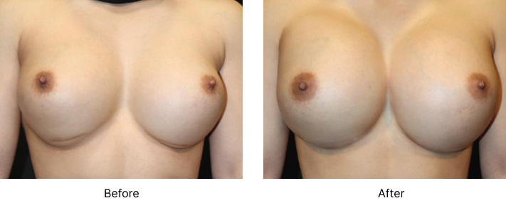 Breast Revision Before and After Las Vegas