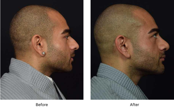 Chin Augmentation Before and After Result Las Vegas