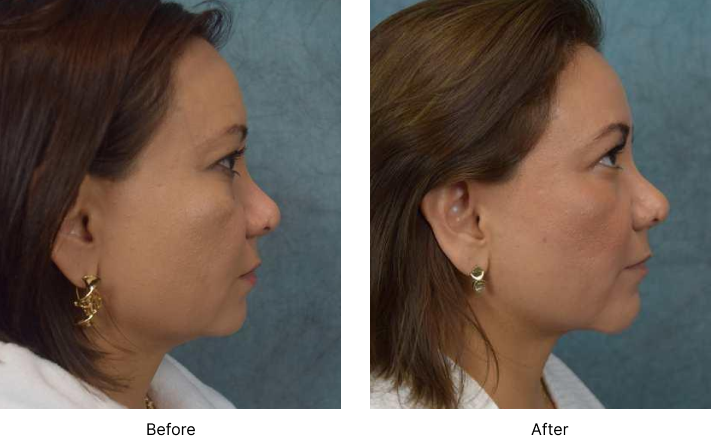 Chin Augmentation Before and After Result Las Vegas