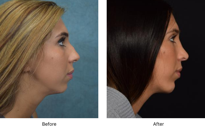 Chin Augmentation Before and After Las Vegas