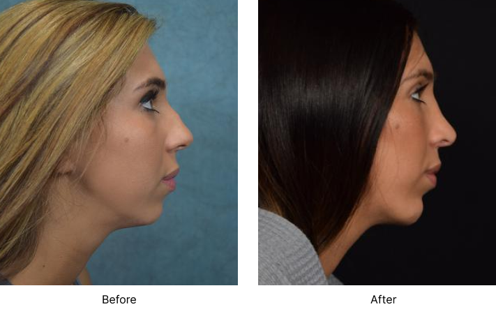 Chin Augmentation Before and After Las Vegas