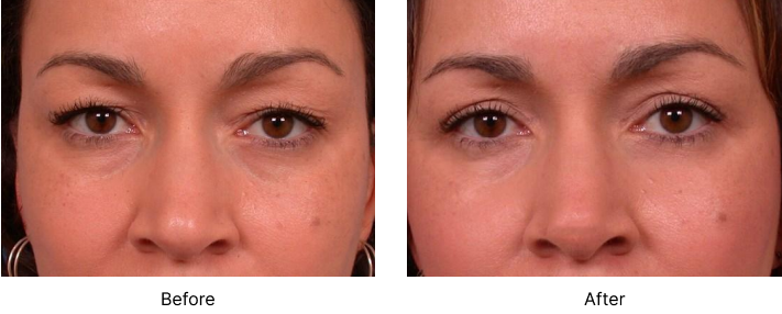 Eyelid Lift Before and After Las Vegas