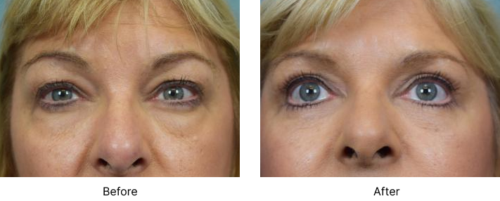 Eyelid Lift Before and After Las Vegas