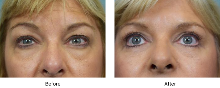 Eyelid Lift Before and After Las Vegas