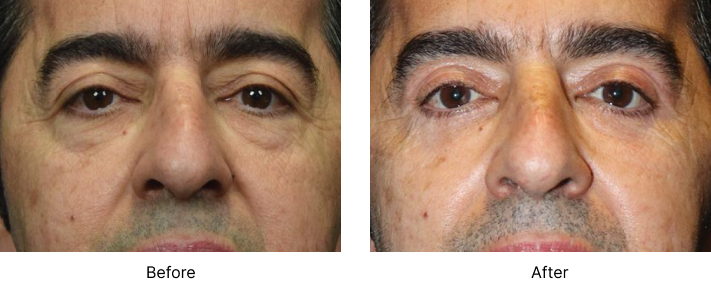 Eyelid Lift Before and After Las Vegas