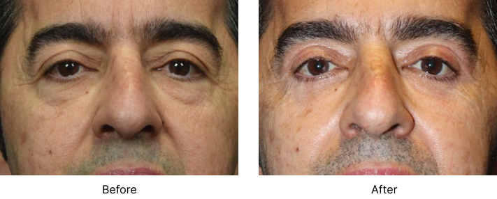 Eyelid Lift Before and After Las Vegas