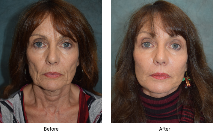 Facelift Before and After Las Vegas