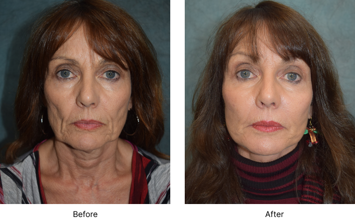 Facelift Before and After Las Vegas