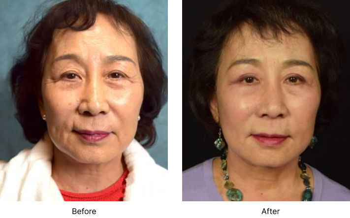 Facelift Before and After Las Vegas