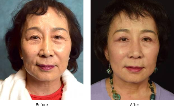 Facelift Before and After Las Vegas