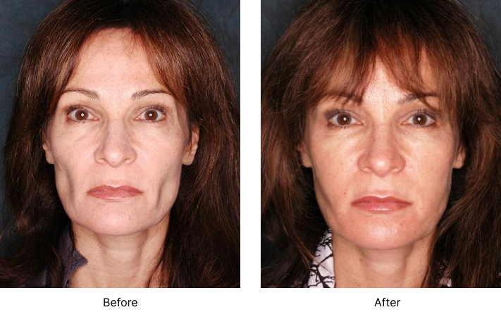 Facial Fat Transfer Before and After Las Vegas