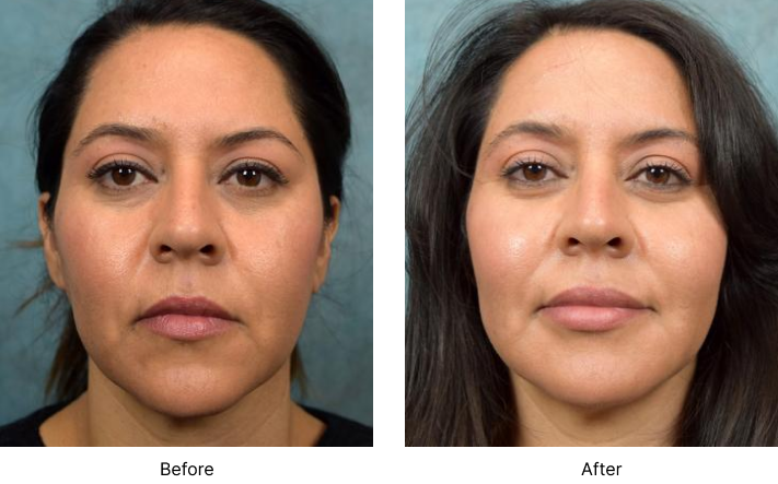 Facial Fat Transfer Before and After Las Vegas