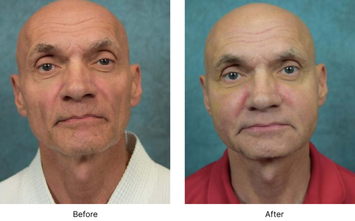 Facial Fat Transfer Before and After Las Vegas