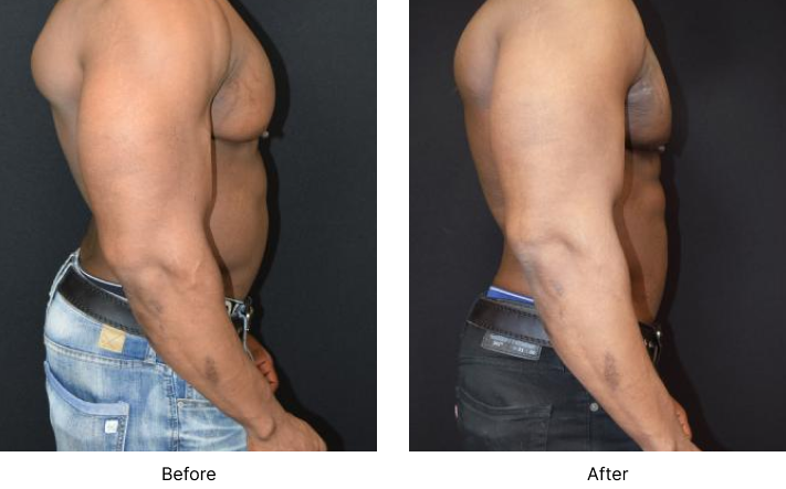 Gynecomastia Before and After Las Vegas