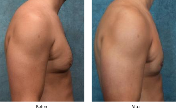 Gynecomastia Before and After Las Vegas