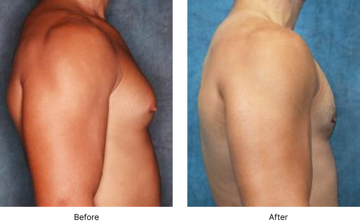 Gynecomastia Before and After Las Vegas