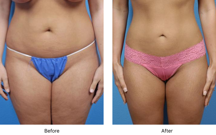 Liposuction Before and After Las Vegas