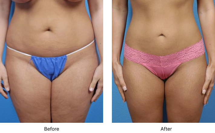 Liposuction Before and After Las Vegas