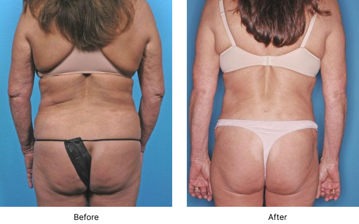 Liposuction Before and After Las Vegas