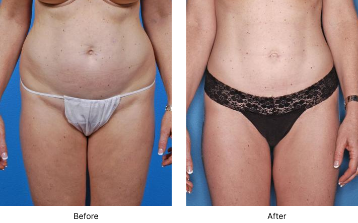 Liposuction Before and After Las Vegas