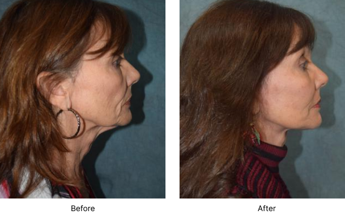 Neck Lift Before and After Las Vegas