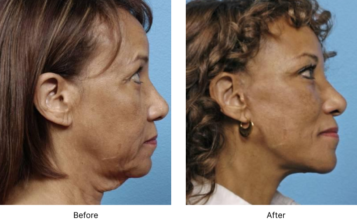 Neck Lift Before and After Las Vegas