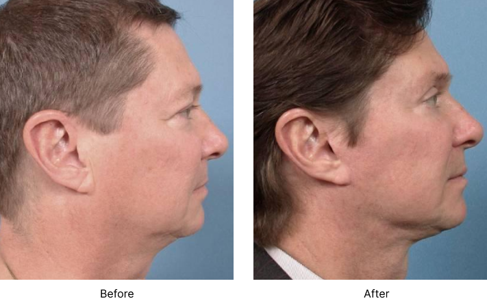 Neck Lift Before and After Las Vegas