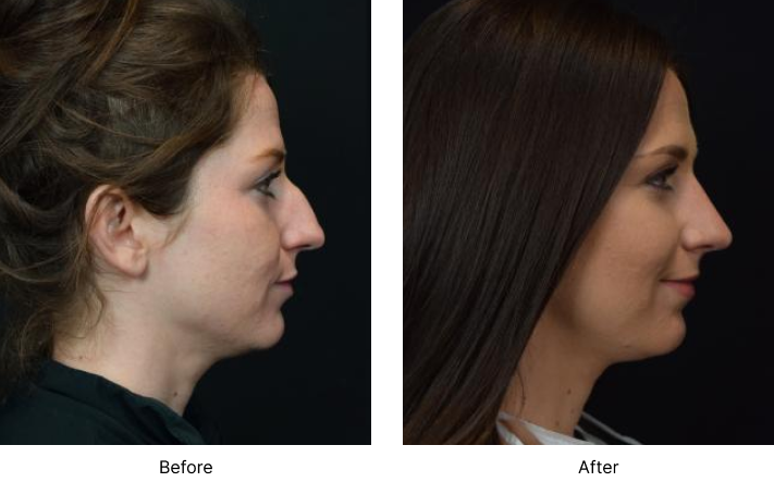 Rhinoplasty Before and After Las Vegas