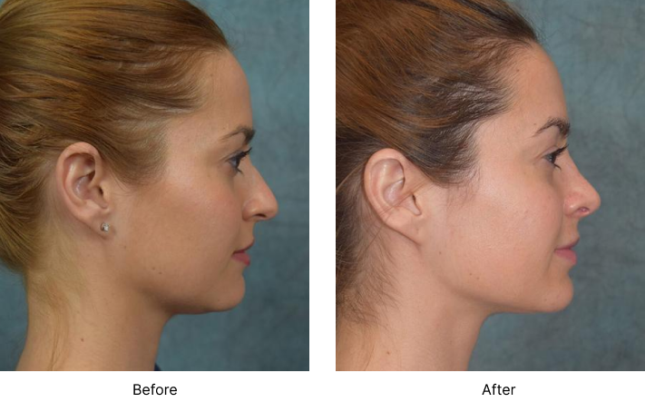 Rhinoplasty Before and After Las Vegas