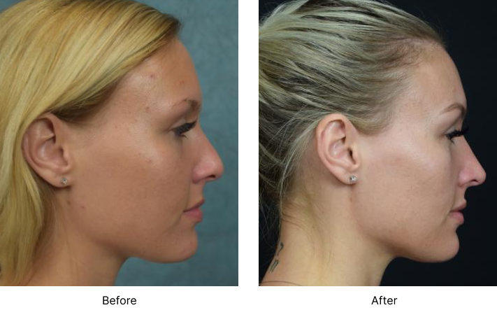 Rhinoplasty Before and After Las Vegas