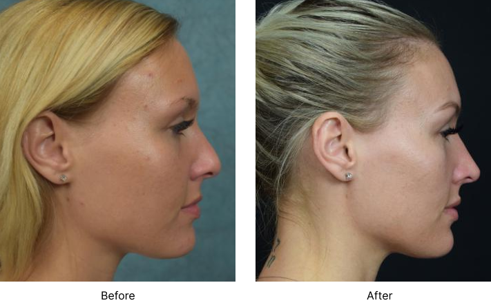 Rhinoplasty Before and After Las Vegas