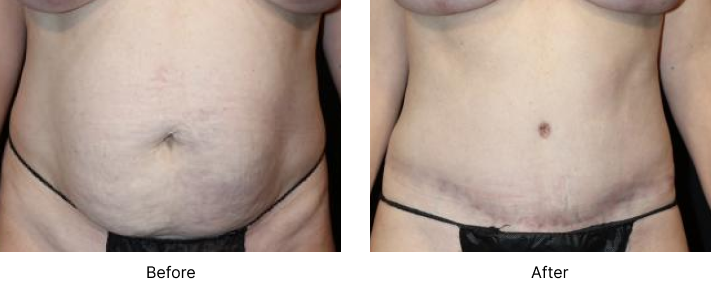 Tummy Tuck Before and After Las Vegas