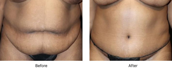 Tummy Tuck Before and After Las Vegas