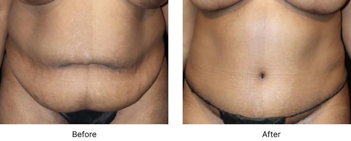 Tummy Tuck Before and After Las Vegas