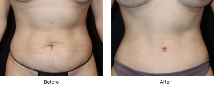 Tummy Tuck Before and After Las Vegas