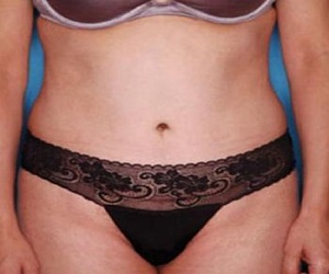 Tummy Tuck Before and After Las Vegas