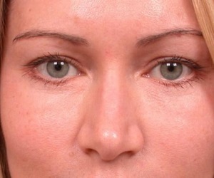 Eyelid Lift Before and After Las Vegas