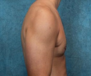 Gynecomastia Before and After Las Vegas