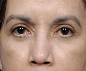 Blepharoplasty Before and After Las Vegas