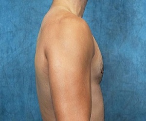 Gynecomastia Before and After Las Vegas