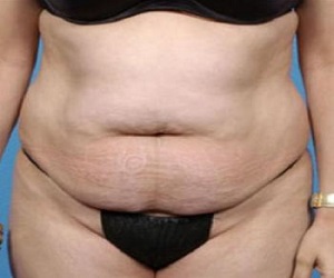 Tummy Tuck Before and After Las Vegas