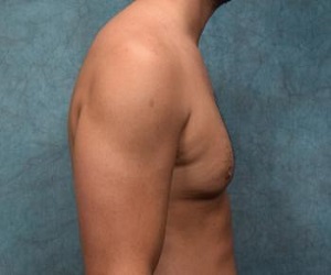 Gynecomastia Before and After Las Vegas