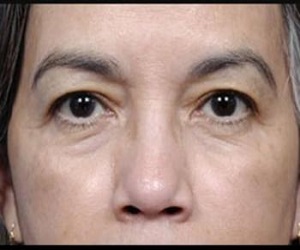 Blepharoplasty Before and After Las Vegas