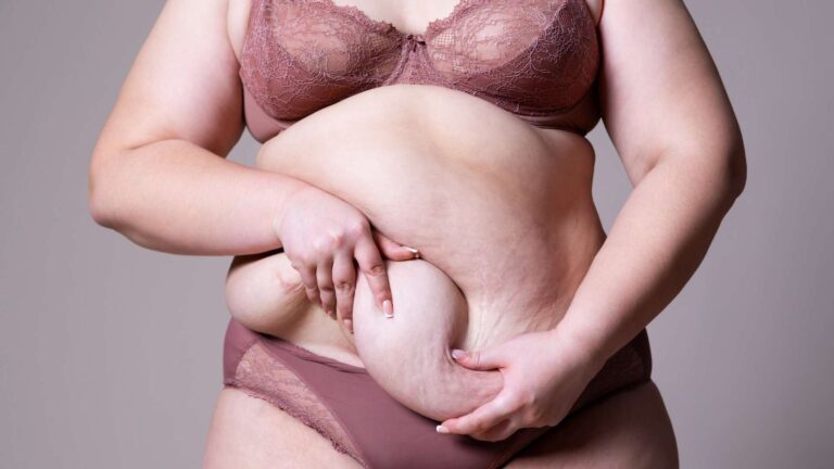 How Much Does a Tummy Tuck Cost in 2025?
